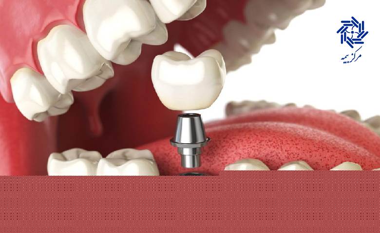 کدام بیمه تکمیلی شامل ایمپلنت میشود؟